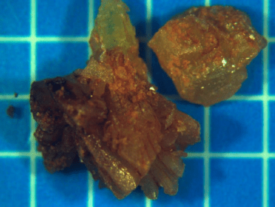 Batu Kencing Misterius Terkait Obat FIP